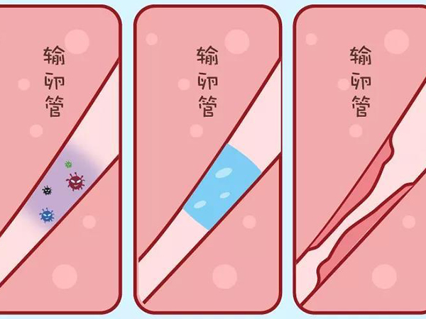 输卵管堵塞会影响卵子排出