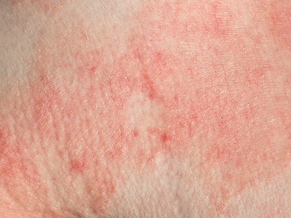 脂溢性皮炎可服用甘草鋅膠囊