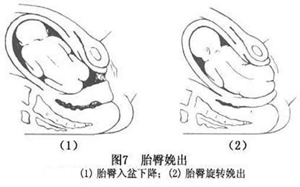 正臀位到32-34周就会转过来