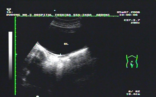 始基子宮超聲診斷