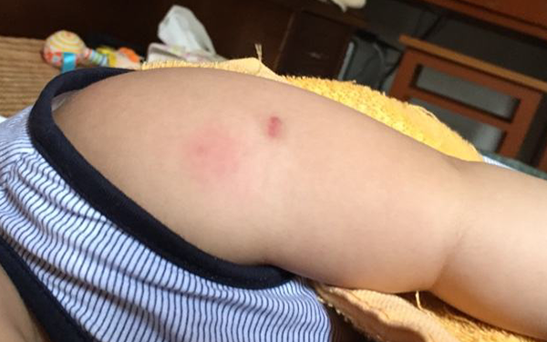 打了百白破可以用暖寶寶熱敷