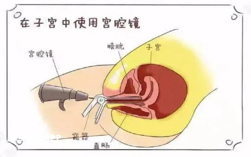 宮腔鏡檢查的危害